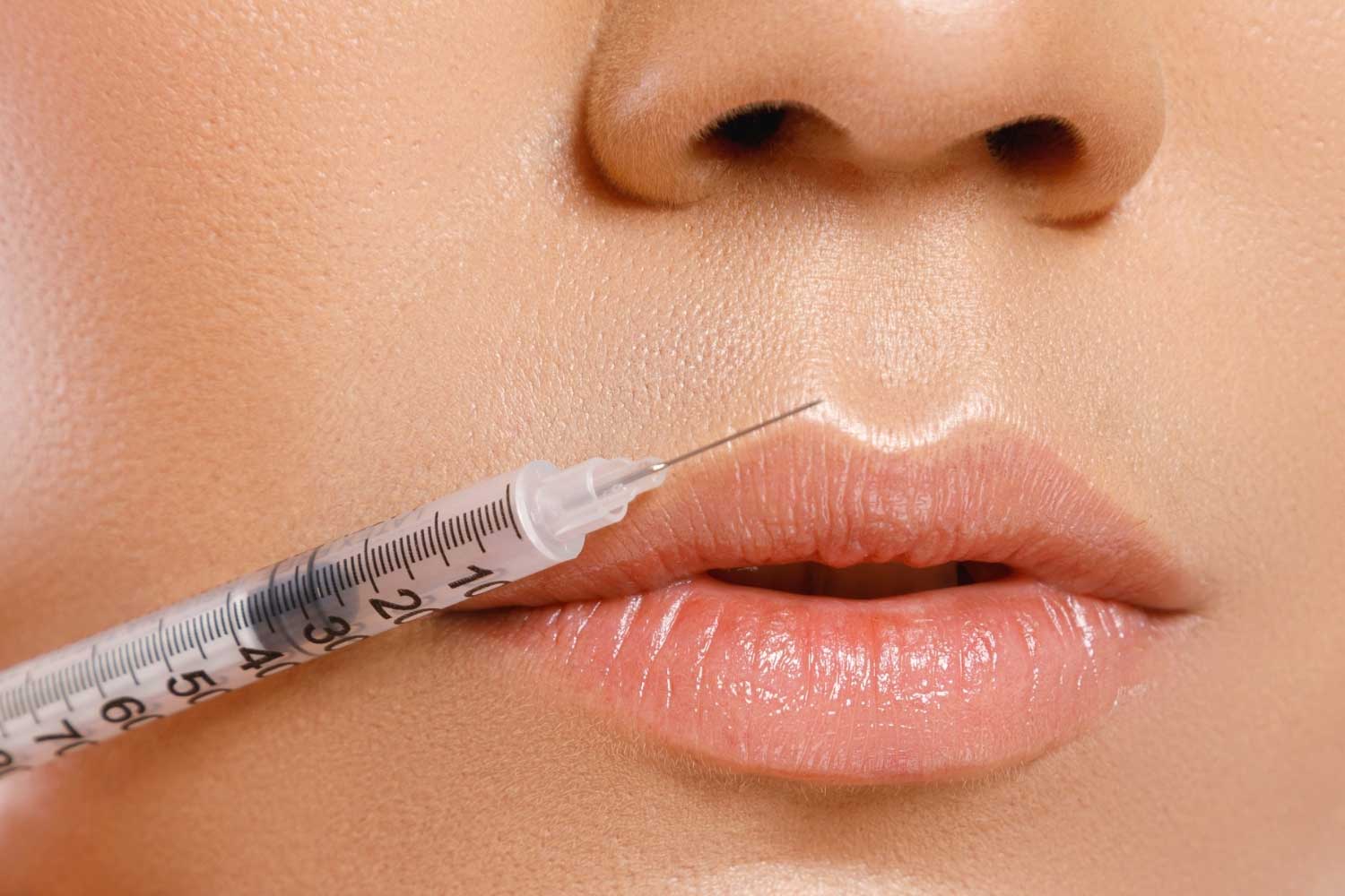 Lip Fillers Near Me