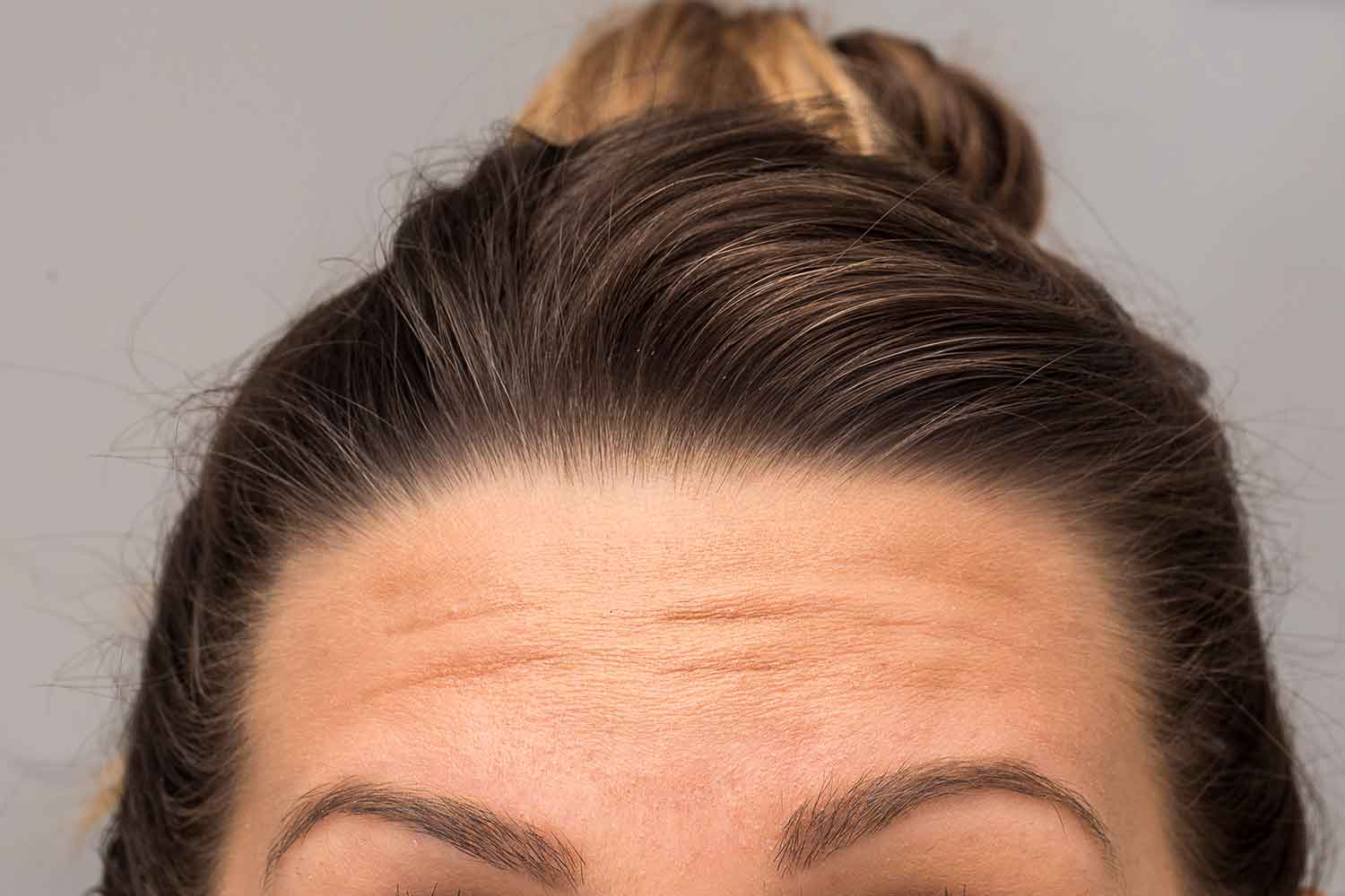 Frown Line Treatment