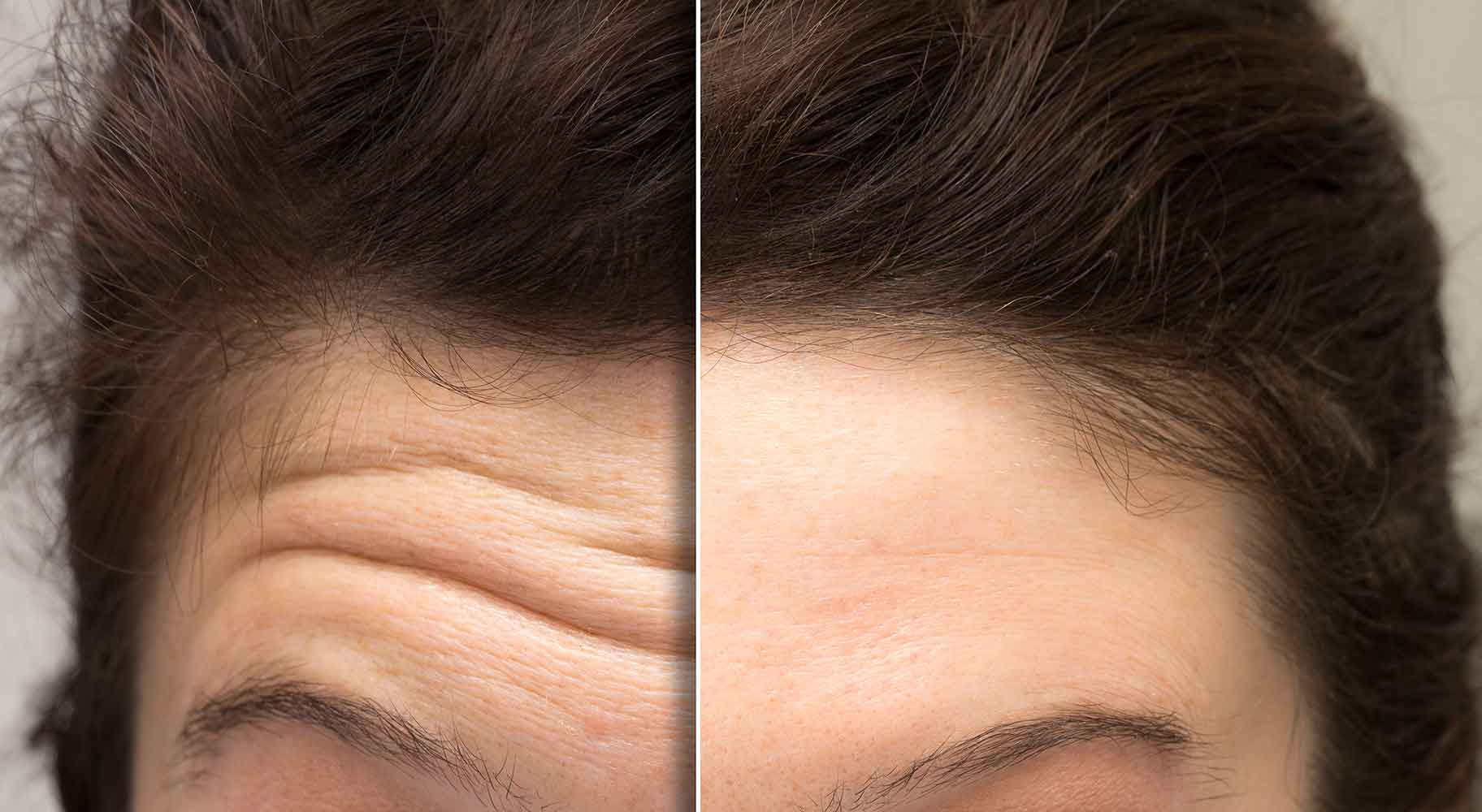 Before and after frownline treatment