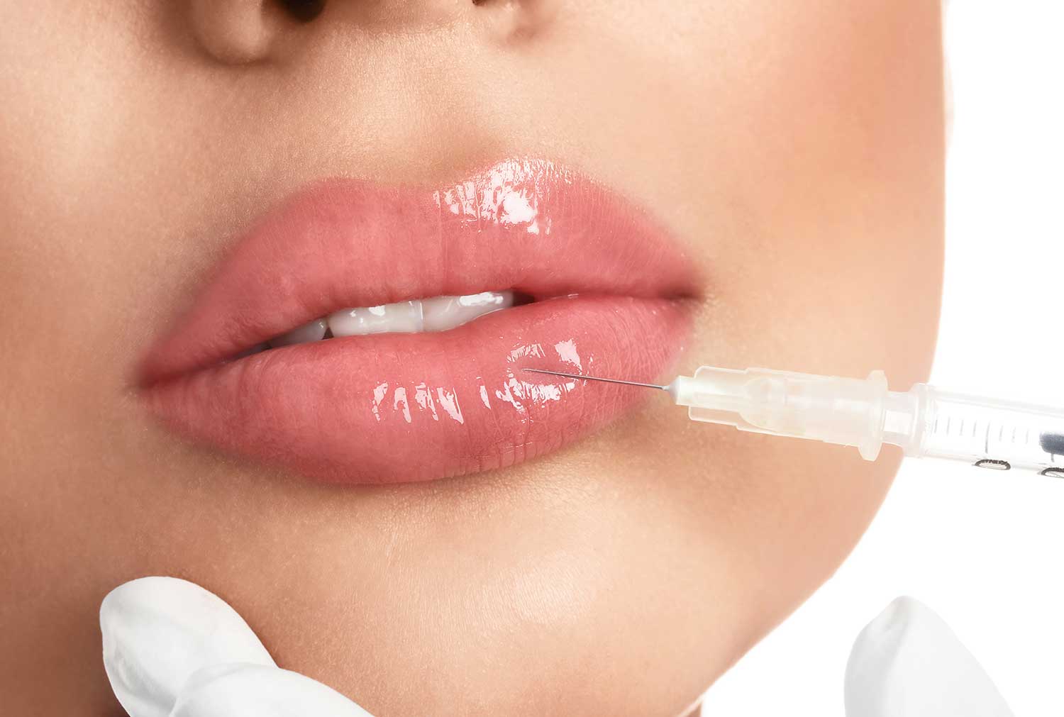 About Lip Fillers Colchester