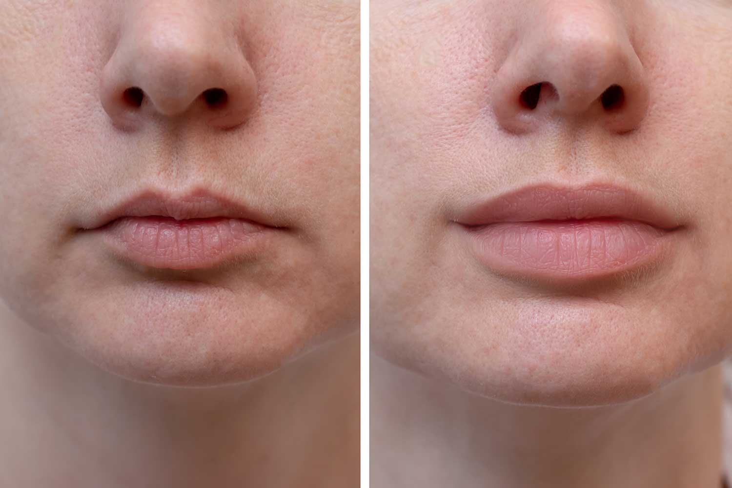 The Benefits of Lip Fillers Colchester
