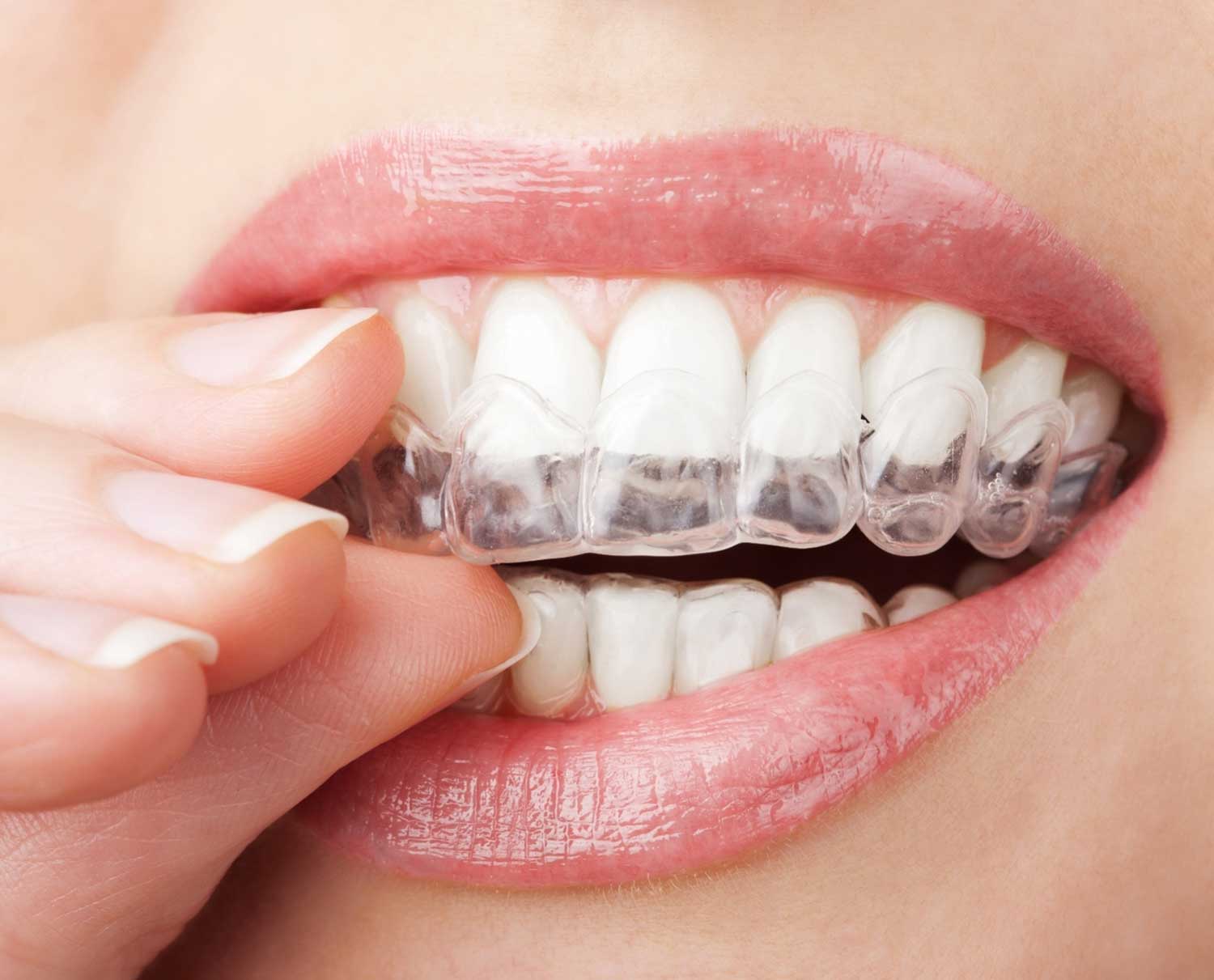 Teeth Whitening in Colchester