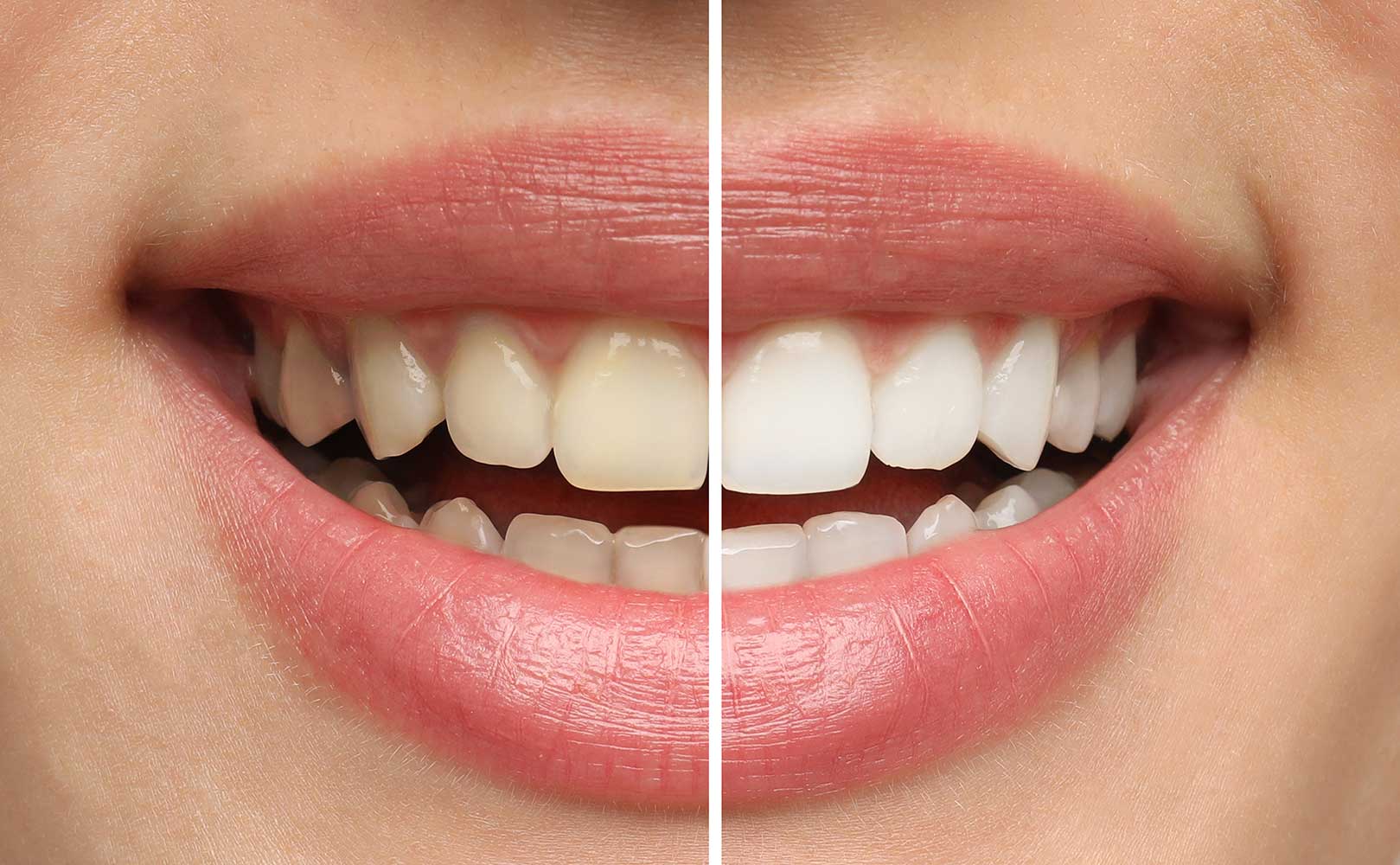 About Teeth Whitening Colchester